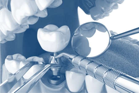 Zahnzusatzversicherung als Ergänzung